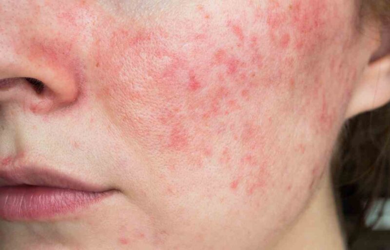 Love The Skin You're In - Rosacea