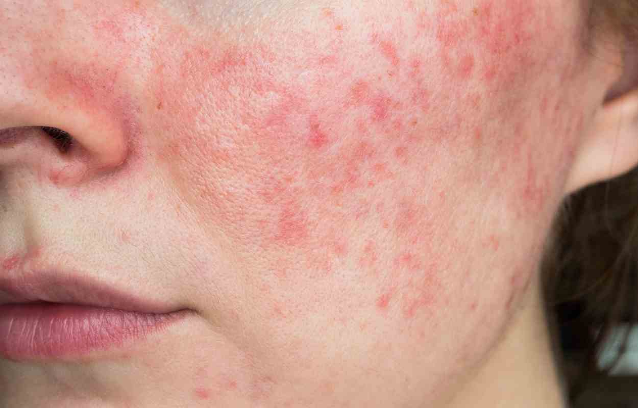 Love The Skin You’re In – Rosacea