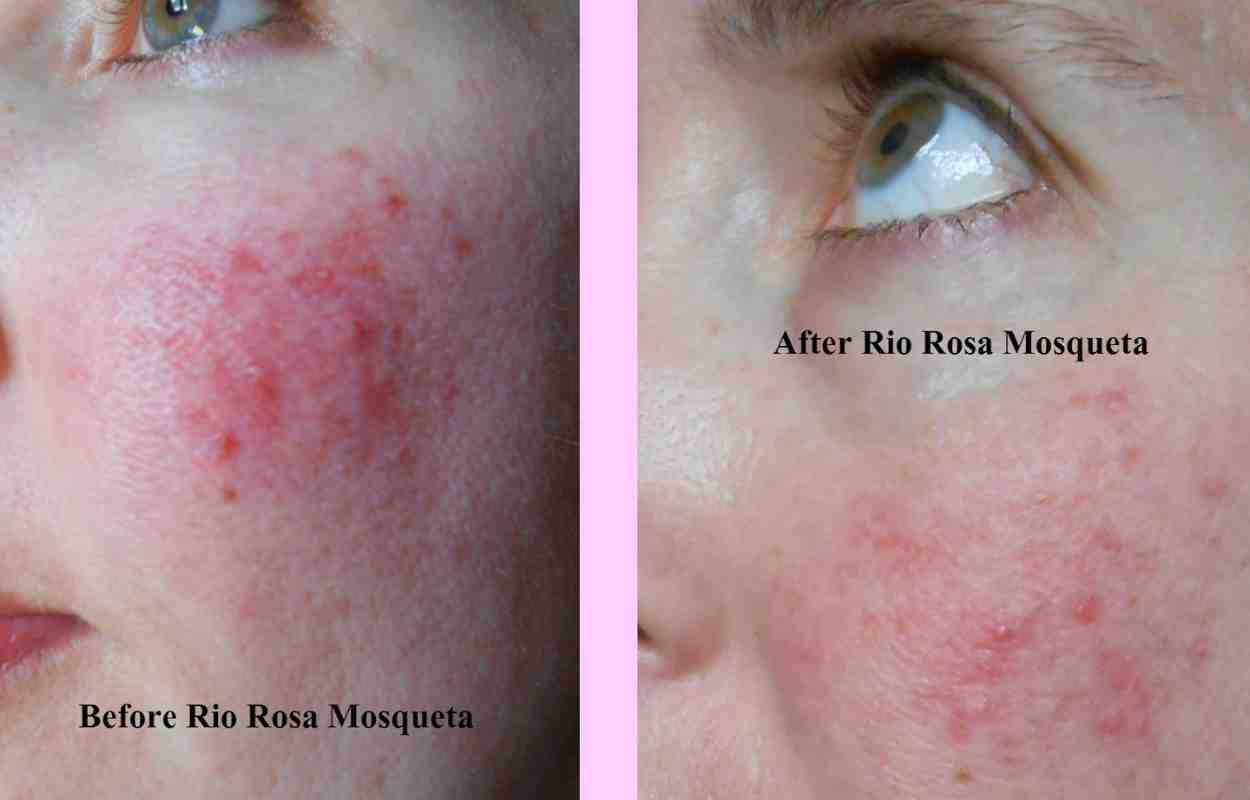 Rio Rosa Mosqueta oil - Product Review On Rosacea Skin
