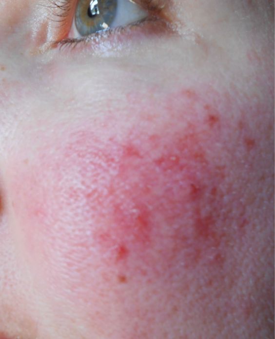 rosacea