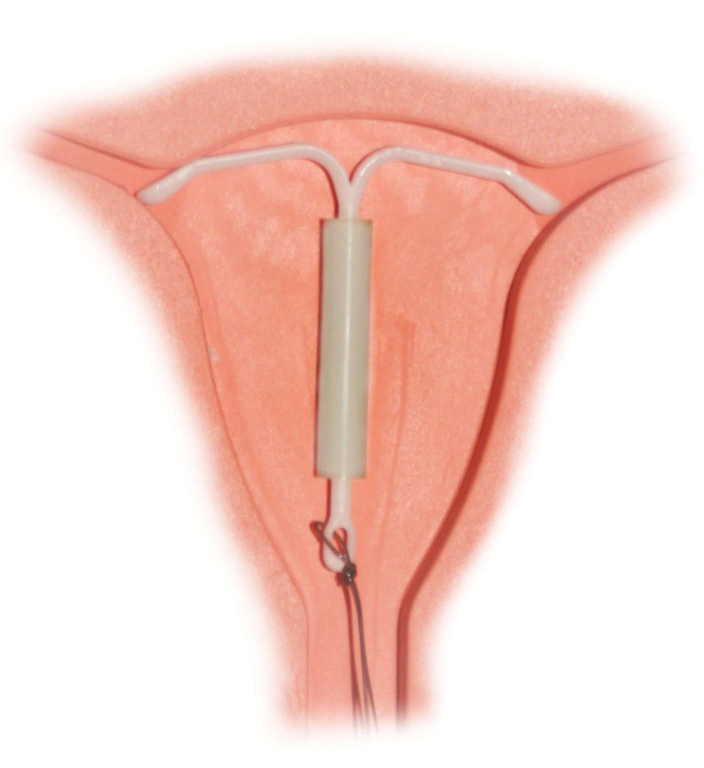 What Are The Side Effects Of Mirena IUD?