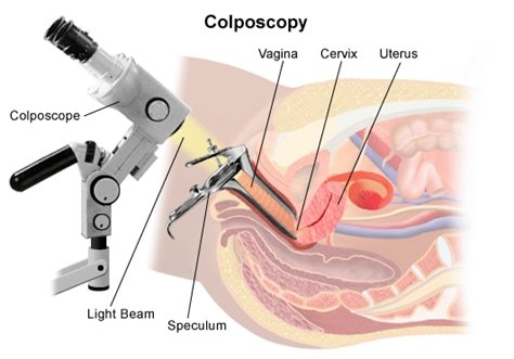 colposcopy